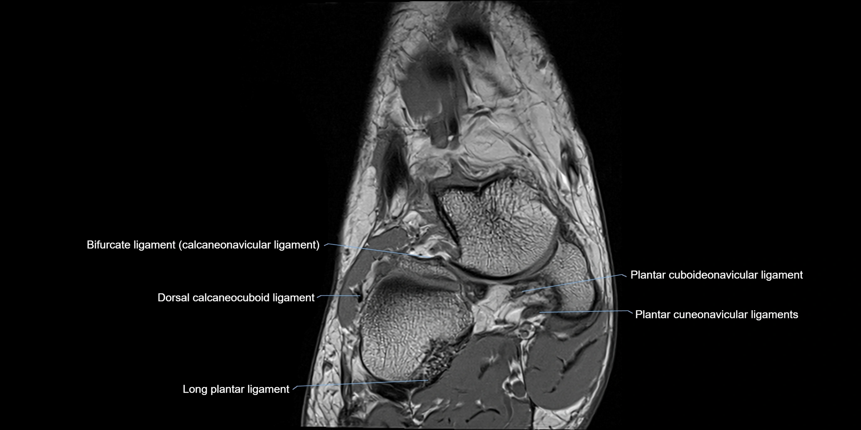 MRI Ankle coronal ligaments cross sectional anatomy 3T  radiology  image-img-00001-00003.webp